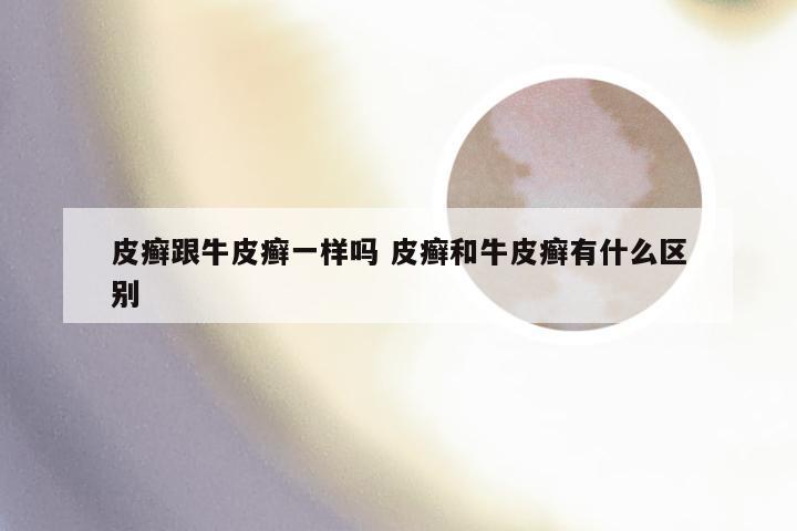 皮癣跟牛皮癣一样吗 皮癣和牛皮癣有什么区别