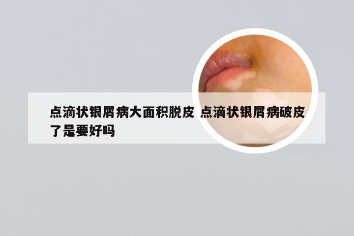 点滴状银屑病大面积脱皮 点滴状银屑病破皮了是要好吗