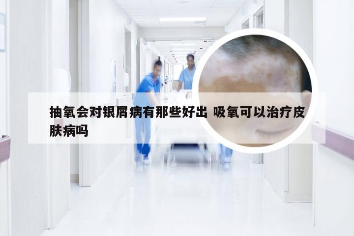 抽氧会对银屑病有那些好出 吸氧可以治疗皮肤病吗