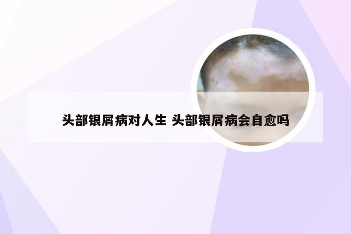头部银屑病对人生 头部银屑病会自愈吗