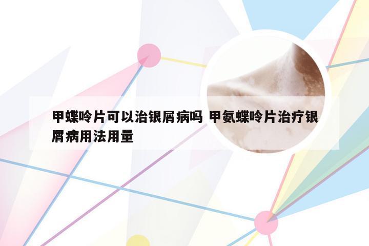 甲蝶呤片可以治银屑病吗 甲氨蝶呤片治疗银屑病用法用量
