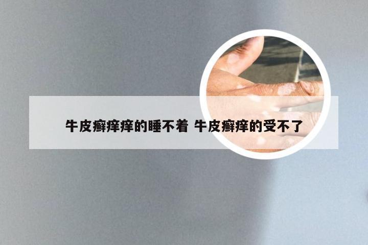 牛皮癣痒痒的睡不着 牛皮癣痒的受不了