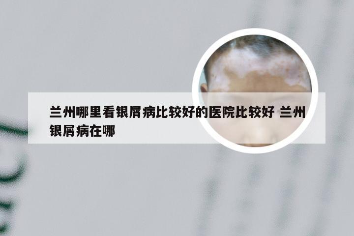 兰州哪里看银屑病比较好的医院比较好 兰州银屑病在哪