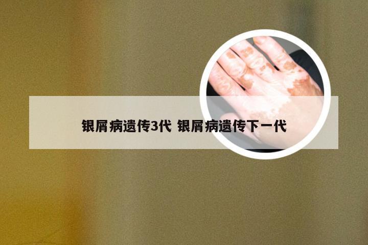 银屑病遗传3代 银屑病遗传下一代