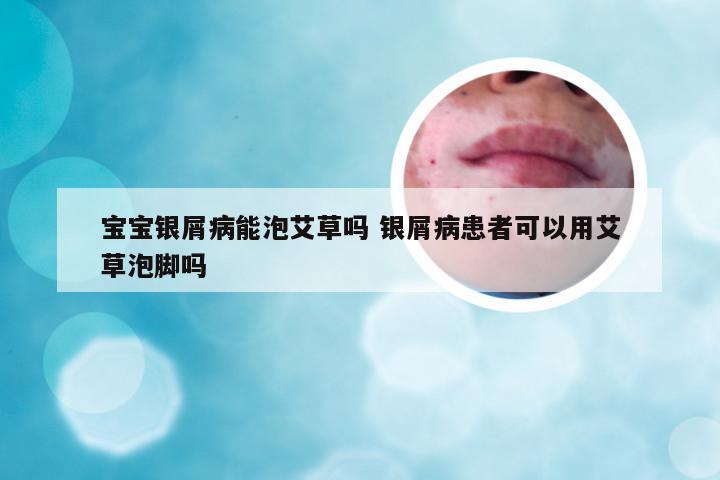 宝宝银屑病能泡艾草吗 银屑病患者可以用艾草泡脚吗