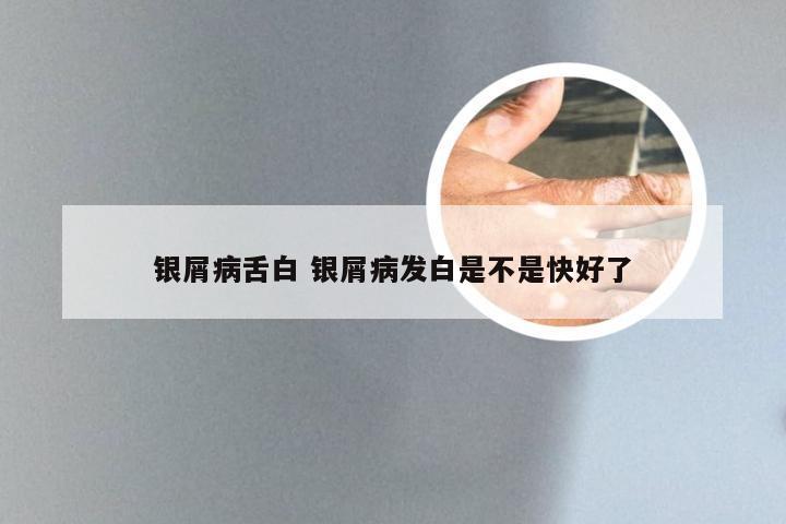 银屑病舌白 银屑病发白是不是快好了