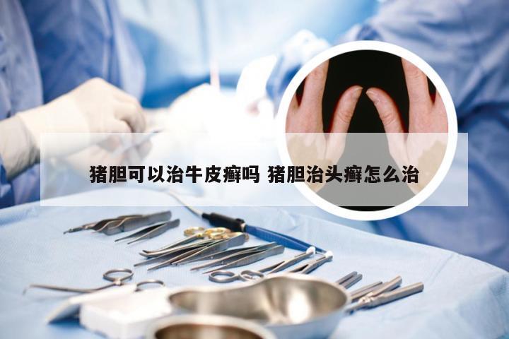 猪胆可以治牛皮癣吗 猪胆治头癣怎么治