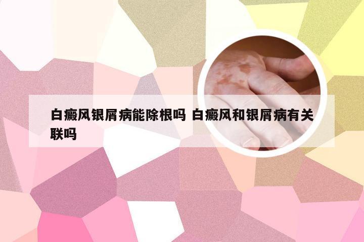 白癜风银屑病能除根吗 白癜风和银屑病有关联吗