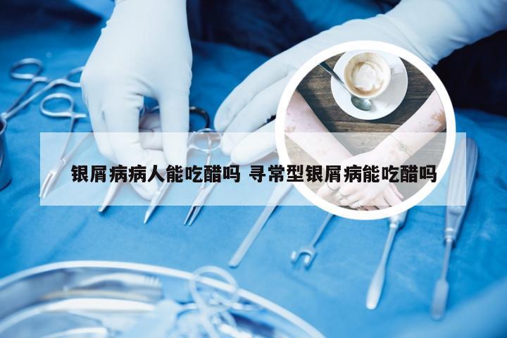 银屑病病人能吃醋吗 寻常型银屑病能吃醋吗
