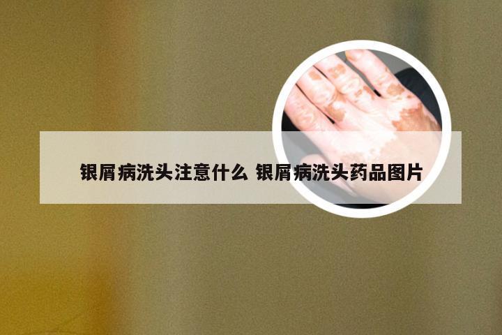 银屑病洗头注意什么 银屑病洗头药品图片