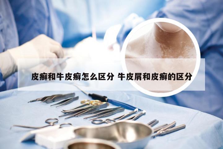 皮癣和牛皮癣怎么区分 牛皮屑和皮癣的区分