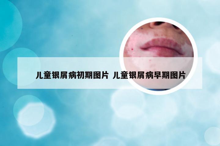 儿童银屑病初期图片 儿童银屑病早期图片