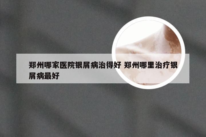 郑州哪家医院银屑病治得好 郑州哪里治疗银屑病最好