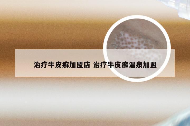 治疗牛皮癣加盟店 治疗牛皮癣温泉加盟