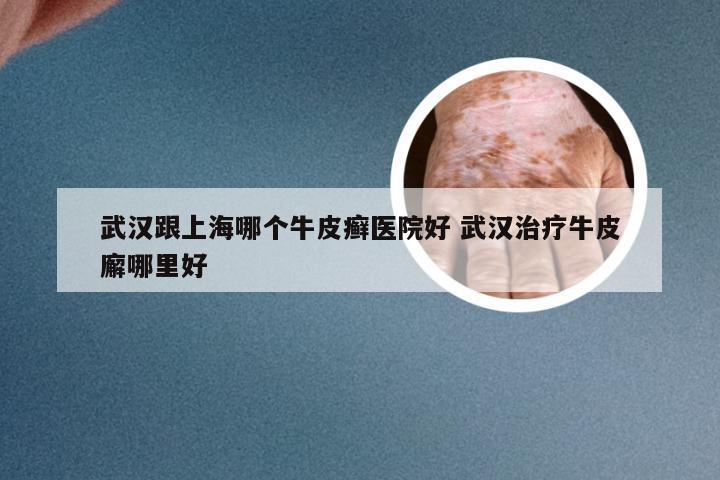 武汉跟上海哪个牛皮癣医院好 武汉治疗牛皮廨哪里好