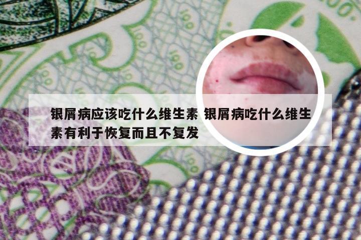 银屑病应该吃什么维生素 银屑病吃什么维生素有利于恢复而且不复发