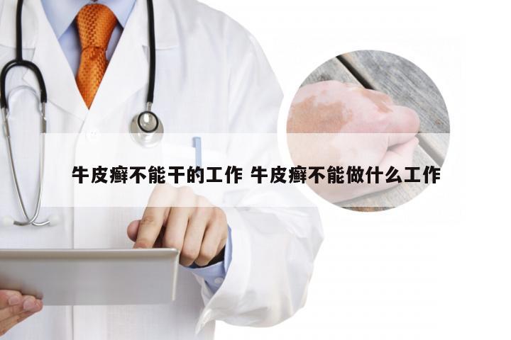 牛皮癣不能干的工作 牛皮癣不能做什么工作