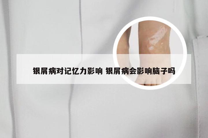 银屑病对记忆力影响 银屑病会影响脑子吗