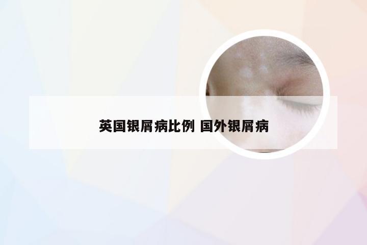 英国银屑病比例 国外银屑病