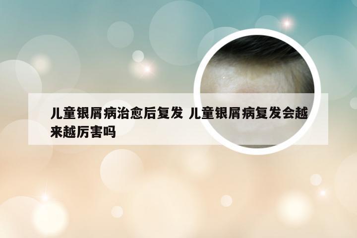 儿童银屑病治愈后复发 儿童银屑病复发会越来越厉害吗