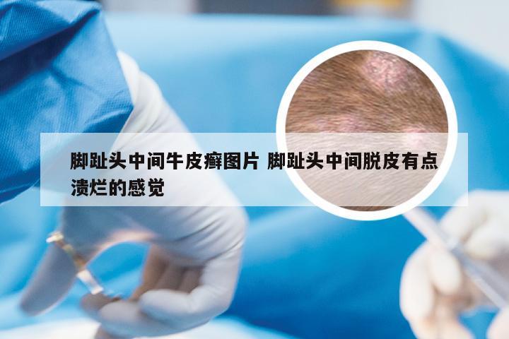 脚趾头中间牛皮癣图片 脚趾头中间脱皮有点溃烂的感觉