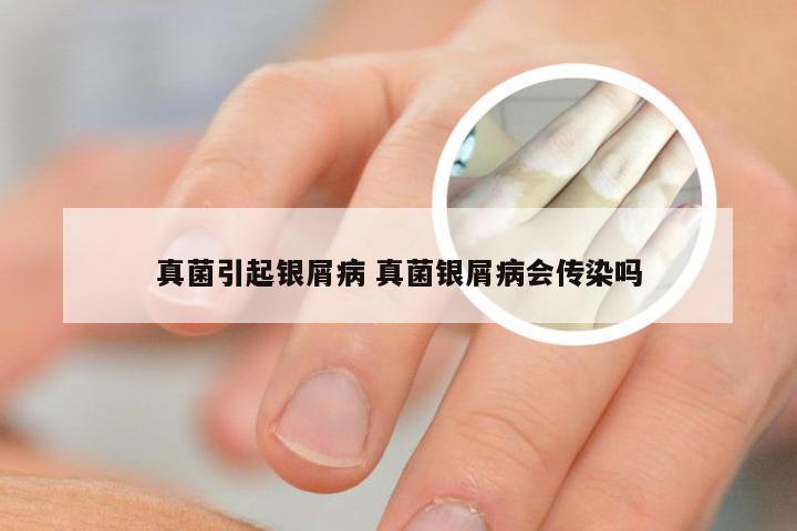 真菌引起银屑病 真菌银屑病会传染吗