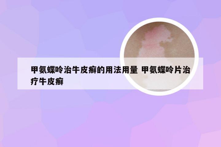 甲氨蝶呤治牛皮癣的用法用量 甲氨蝶呤片治疗牛皮癣