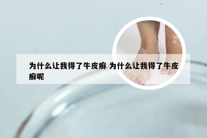 为什么让我得了牛皮癣 为什么让我得了牛皮癣呢