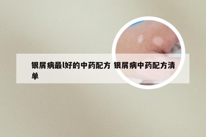 银屑病最l好的中药配方 银屑病中药配方清单