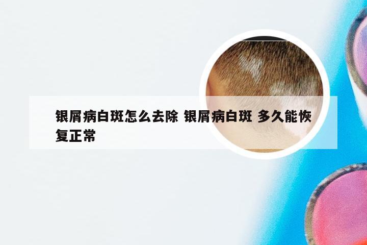 银屑病白斑怎么去除 银屑病白斑 多久能恢复正常