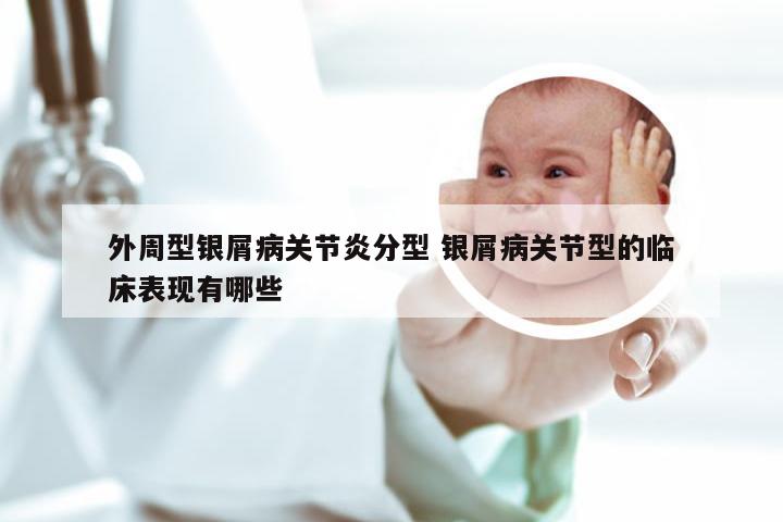 外周型银屑病关节炎分型 银屑病关节型的临床表现有哪些
