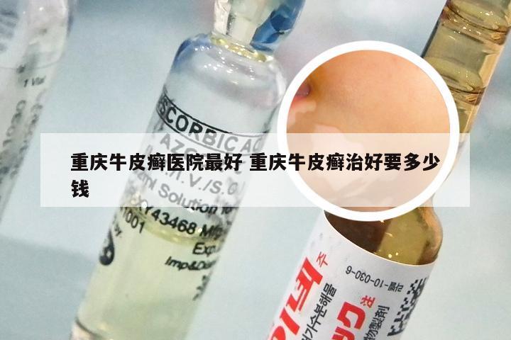 重庆牛皮癣医院最好 重庆牛皮癣治好要多少钱