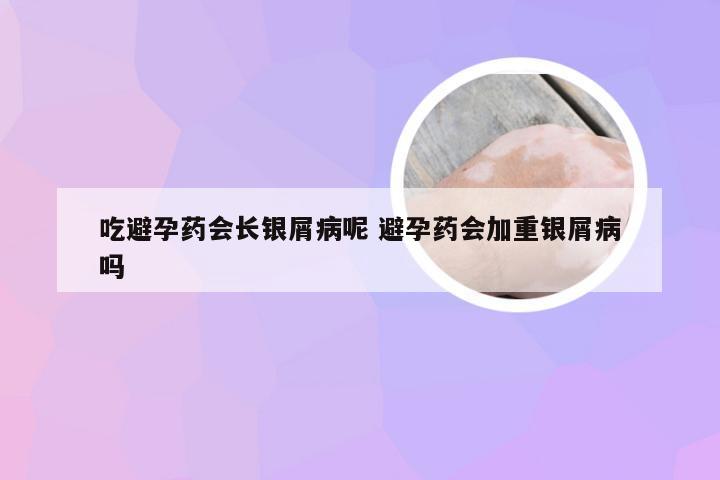 吃避孕药会长银屑病呢 避孕药会加重银屑病吗
