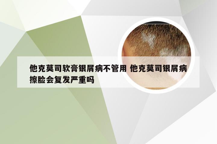 他克莫司软膏银屑病不管用 他克莫司银屑病擦脸会复发严重吗