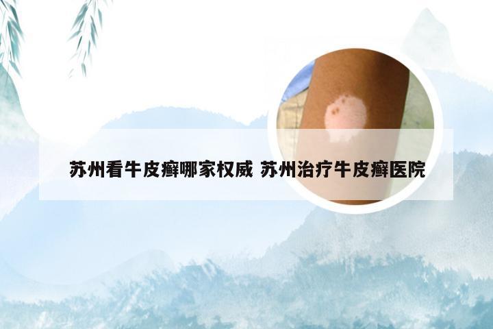 苏州看牛皮癣哪家权威 苏州治疗牛皮癣医院