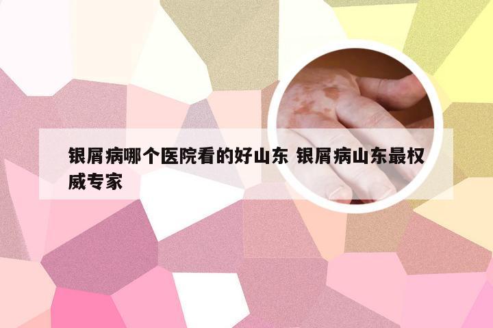 银屑病哪个医院看的好山东 银屑病山东最权威专家