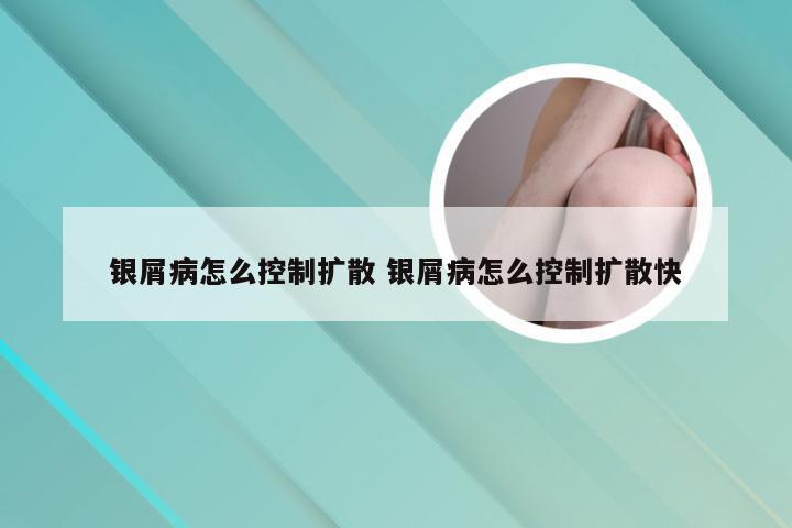 银屑病怎么控制扩散 银屑病怎么控制扩散快