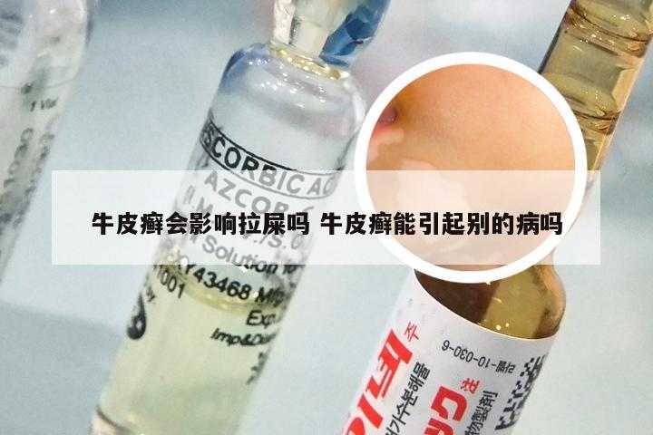 牛皮癣会影响拉屎吗 牛皮癣能引起别的病吗