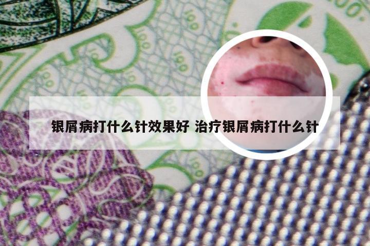 银屑病打什么针效果好 治疗银屑病打什么针