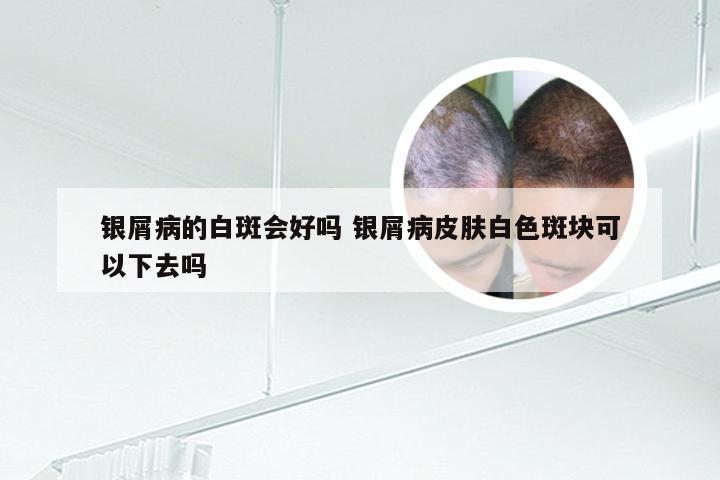 银屑病的白斑会好吗 银屑病皮肤白色斑块可以下去吗