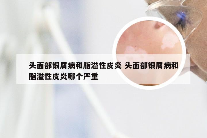 头面部银屑病和脂溢性皮炎 头面部银屑病和脂溢性皮炎哪个严重