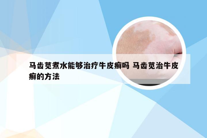 马齿苋煮水能够治疗牛皮癣吗 马齿苋治牛皮癣的方法