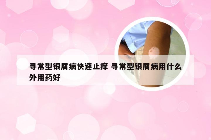 寻常型银屑病快速止痒 寻常型银屑病用什么外用药好