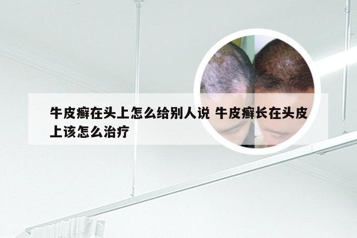 牛皮癣在头上怎么给别人说 牛皮癣长在头皮上该怎么治疗