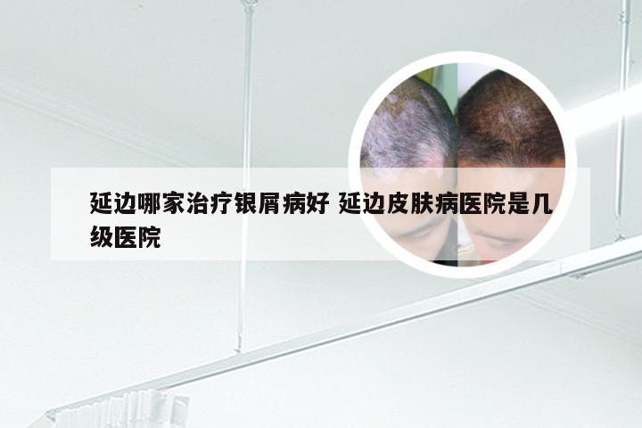 延边哪家治疗银屑病好 延边皮肤病医院是几级医院