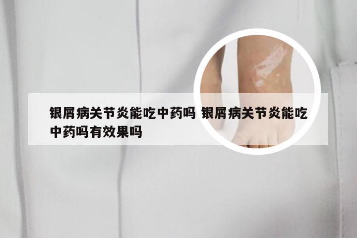 银屑病关节炎能吃中药吗 银屑病关节炎能吃中药吗有效果吗