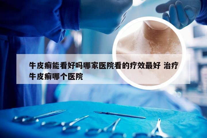 牛皮癣能看好吗哪家医院看的疗效最好 治疗牛皮癣哪个医院