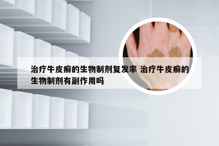 治疗牛皮癣的生物制剂复发率 治疗牛皮癣的生物制剂有副作用吗