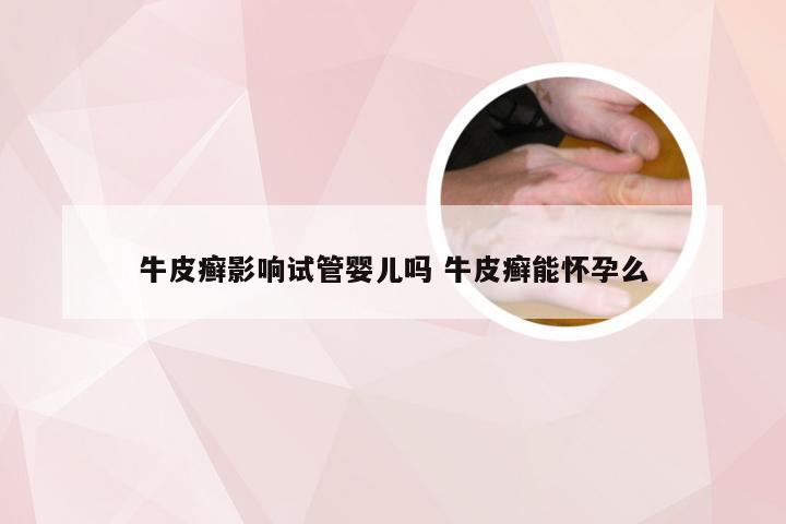 牛皮癣影响试管婴儿吗 牛皮癣能怀孕么