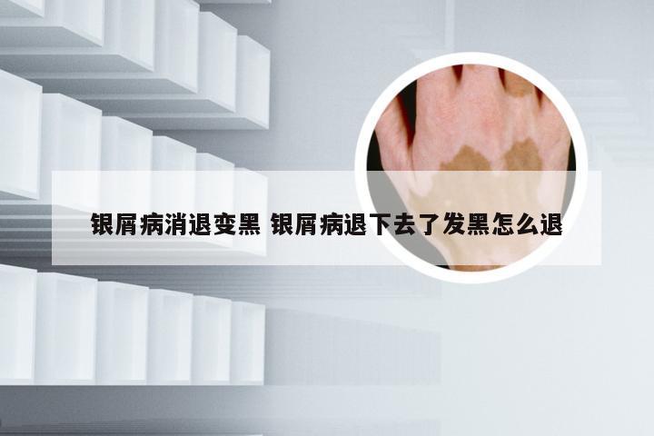 银屑病消退变黑 银屑病退下去了发黑怎么退